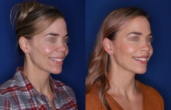 47 year old patient 1+ year post op from a perialar lip lift