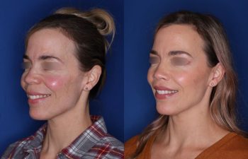 47 year old patient 1+ year post op from a perialar lip lift