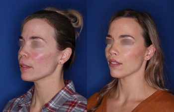 47 year old patient 1+ year post op from a perialar lip lift