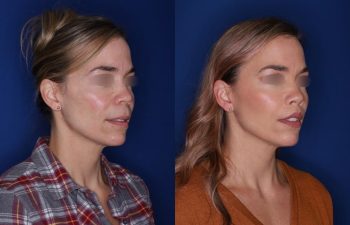 47 year old patient 1+ year post op from a perialar lip lift