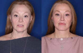 53 year old patient 10 months following an extended mini deep plane facelift, platysmaplasty, upper blepharoplasty, and perialar lip lift.