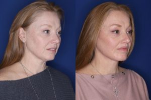 53 year old patient 10 months following an extended mini deep plane facelift, platysmaplasty, upper blepharoplasty, and perialar lip lift.
