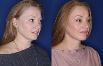 53 year old patient 10 months following an extended mini deep plane facelift, platysmaplasty, upper blepharoplasty, and perialar lip lift.