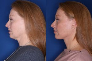 53 year old patient 10 months following an extended mini deep plane facelift, platysmaplasty, upper blepharoplasty, and perialar lip lift.