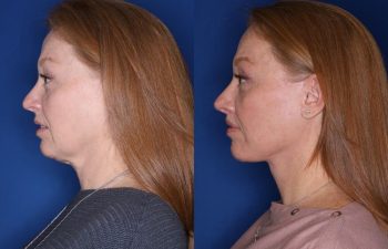 53 year old patient 10 months following an extended mini deep plane facelift, platysmaplasty, upper blepharoplasty, and perialar lip lift.