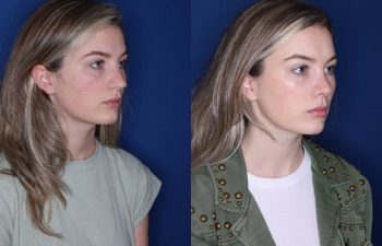25 year old female 6 months post op from cosmetic rhinoplasty