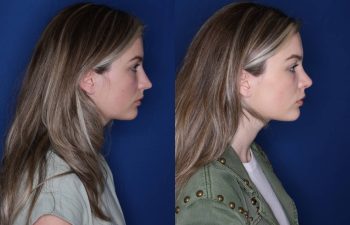 25 year old female 6 months post op from cosmetic rhinoplasty