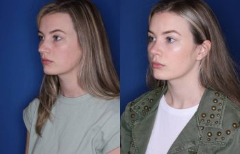 25 year old female 6 months post op from cosmetic rhinoplasty