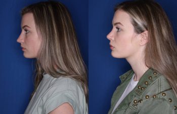 25 year old female 6 months post op from cosmetic rhinoplasty