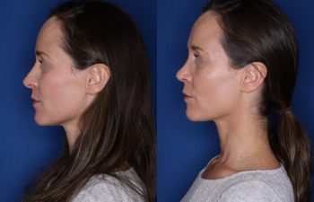 39 year old female 1month post op from a revision cosmetic rhinoplasty.