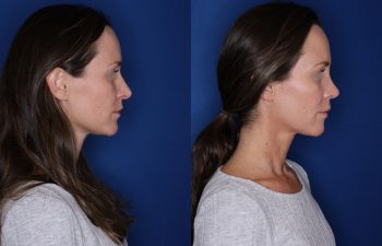 39 year old female 1month post op from a revision cosmetic rhinoplasty.