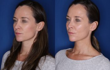 39 year old female 1month post op from a revision cosmetic rhinoplasty.