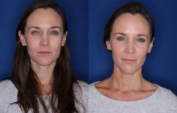 39 year old female 1month post op from a revision cosmetic rhinoplasty.
