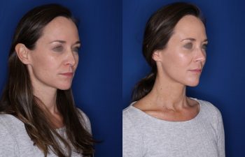 39 year old female 1month post op from a revision cosmetic rhinoplasty.
