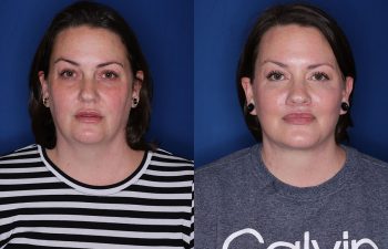 a photo of a patient before and after a cosmetic procedure