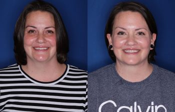 a photo of a patient before and after a cosmetic procedure