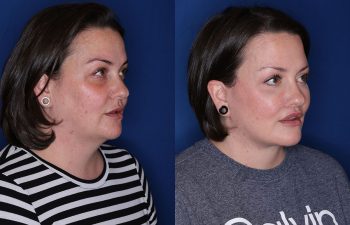 a photo of a patient before and after a cosmetic procedure