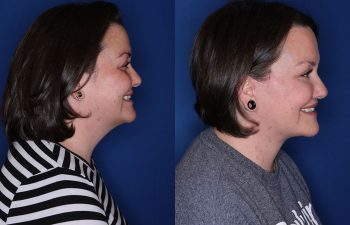 a photo of a patient before and after a cosmetic procedure