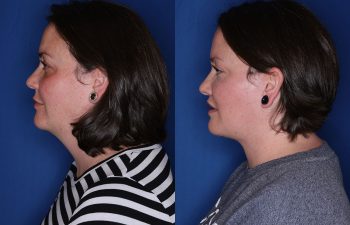 a photo of a patient before and after a cosmetic procedure