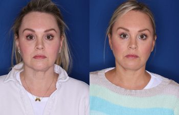 before and after facelift procedure