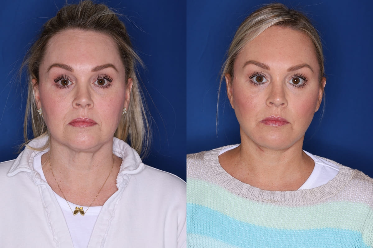 Deep Plane Facelift, Neck Lift