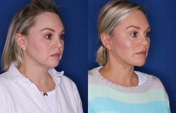 before and after facelift procedure