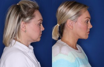before and after facelift procedure