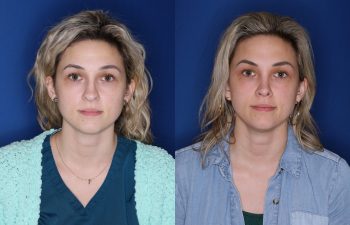 28 year old female 1 year post op from open reduction cosmetic rhinoplasty.