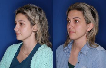 28 year old female 1 year post op from open reduction cosmetic rhinoplasty.