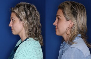 28 year old female 1 year post op from open reduction cosmetic rhinoplasty.