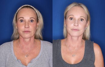 52 year old female 3 months post op from a revision mini extended deep plane facelift