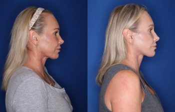52 year old female 3 months post op from a revision mini extended deep plane facelift