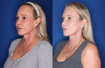 52 year old female 3 months post op from a revision mini extended deep plane facelift