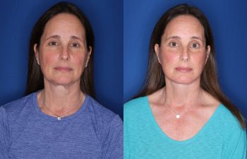 53 year old female 2.5 months postop from a KalosLift mini extended deep plane facelift and temporal brow lift