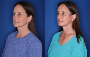 53 year old female 2.5 months postop from a KalosLift mini extended deep plane facelift and temporal brow lift