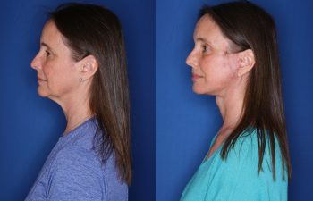 53 year old female 2.5 months postop from a KalosLift mini extended deep plane facelift and temporal brow lift