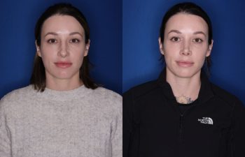 36 year old female 1month post op from a cosmetic rhinoplasty