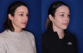 36 year old female 1month post op from a cosmetic rhinoplasty