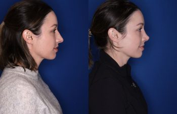 36 year old female 1month post op from a cosmetic rhinoplasty