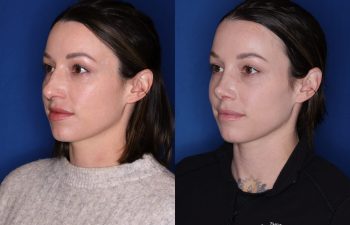 36 year old female 1month post op from a cosmetic rhinoplasty