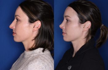36 year old female 1month post op from a cosmetic rhinoplasty