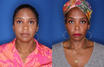 44 year old female 8 months post op from cosmetic open rhinoplasty with alar base nostril reductions, buccal fat pad removal and radio frequency skin tightening