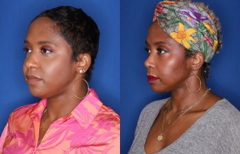 44 year old female 8 months post op from cosmetic open rhinoplasty with alar base nostril reductions, buccal fat pad removal and radio frequency skin tightening