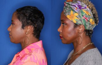 44 year old female 8 months post op from cosmetic open rhinoplasty with alar base nostril reductions, buccal fat pad removal and radio frequency skin tightening