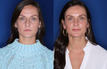 27 year old female over 1 year out from cosmetic rhinoplasty.