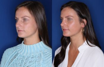 27 year old female over 1 year out from cosmetic rhinoplasty.