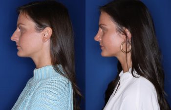 27 year old female over 1 year out from cosmetic rhinoplasty.