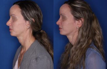 37 year old 2 months post op from cosmetic rhinoplasty