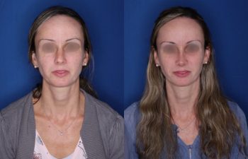 37 year old 2 months post op from cosmetic rhinoplasty