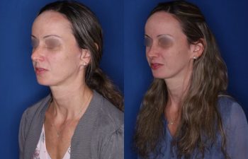 37 year old 2 months post op from cosmetic rhinoplasty